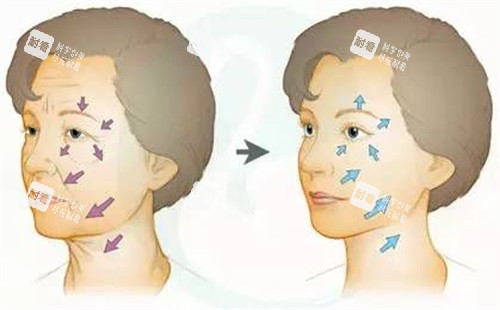 面部除皱对比图