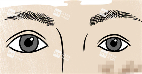 双眼皮大小眼修复 双眼皮大小眼修复