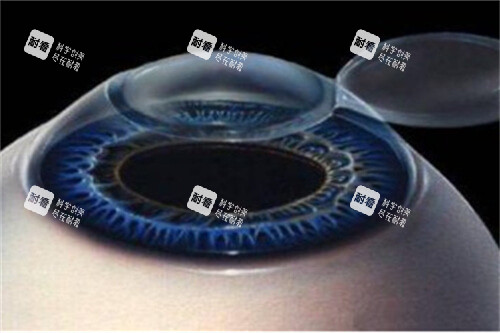 近视眼手术1 近视眼手术1