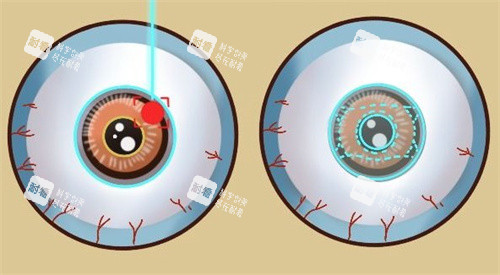 激光类近视手术和ICL晶体植入手术 激光类近视手术和ICL晶体植入手术