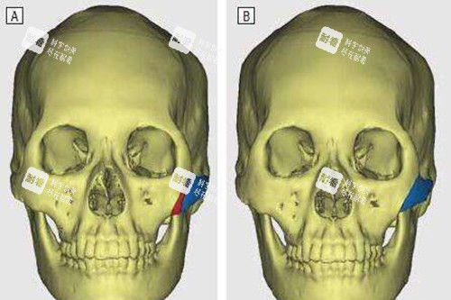 颧骨内推示意图 颧骨内推示意图