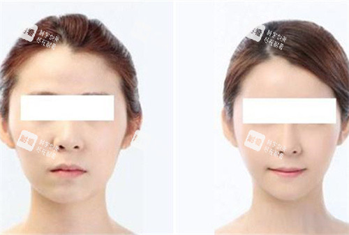 颧骨手术前后对比图 颧骨手术前后对比图