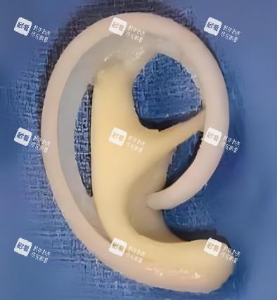 耳再造手术假体照片