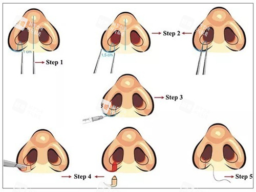 鼻翼缩小手术前后对比