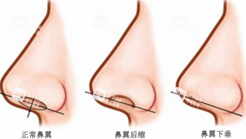 不同鼻翼对比 不同鼻翼对比