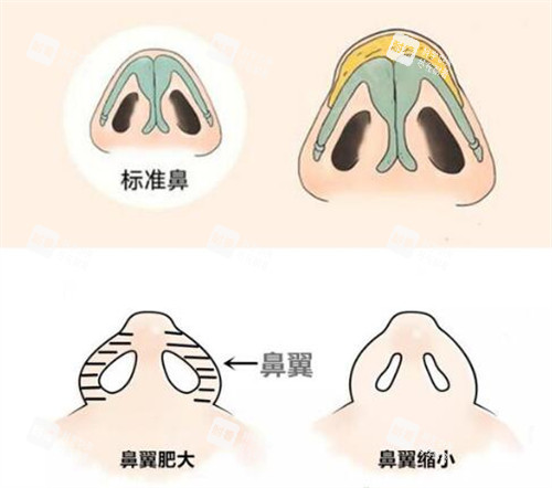 鼻翼缩小改善展示图 鼻翼缩小改善展示图