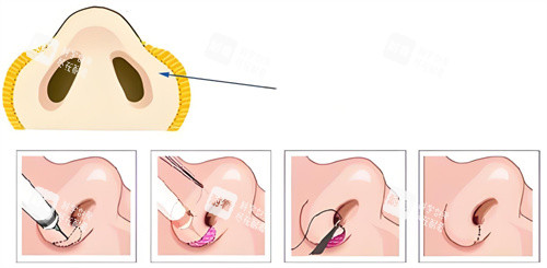 鼻翼缩小手术过程 鼻翼缩小手术过程