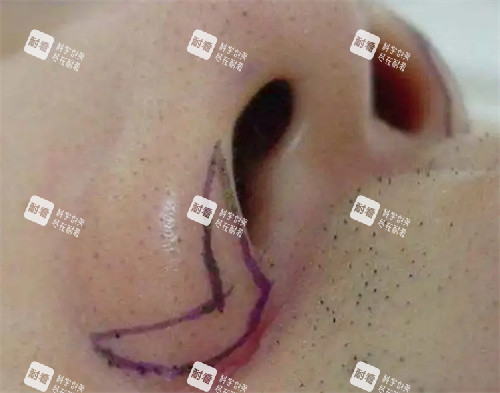 鼻翼切口设计位置图 鼻翼切口设计位置图