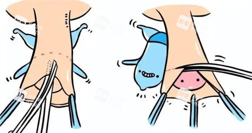 男生割包皮卡通示意图