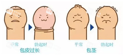 包皮过长和包茎
