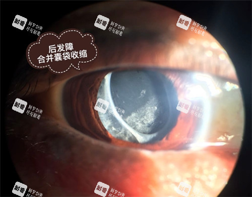 后发障囊带收缩