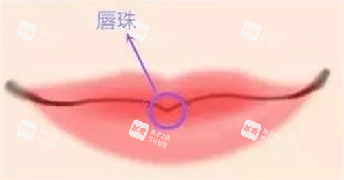 M唇的唇珠 M唇的唇珠