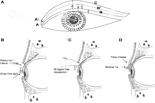 爱尔眼科倒睫手术结果到底如何？专科医生告诉你正规医疗机构的真实体验与术后修复分享！