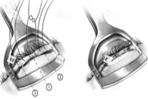 倒睫手术图 倒睫手术图