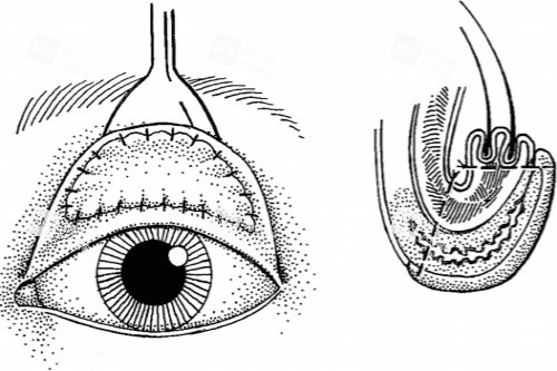 倒睫手术 倒睫手术