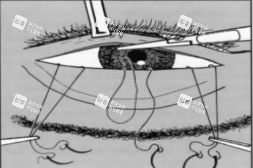 倒睫手术图示 倒睫手术图示