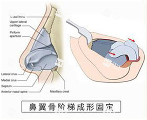 鼻翼骨阶梯成形固定