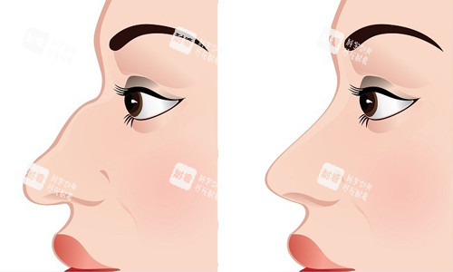 鼻整形前后对比 鼻整形前后对比