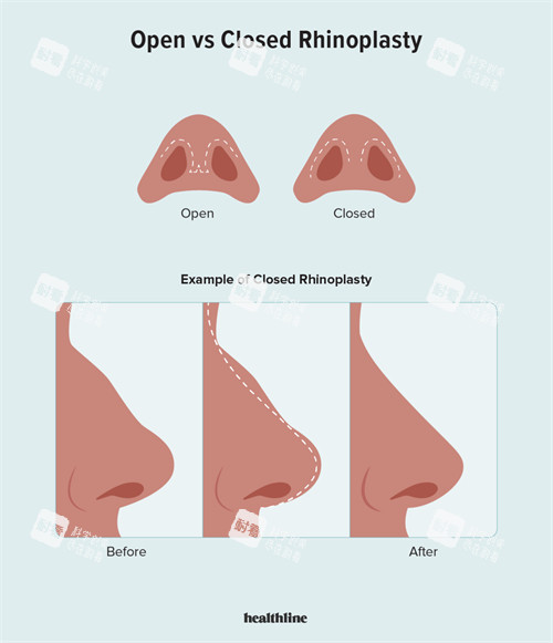 鼻整形前后的对比 鼻整形前后的对比
