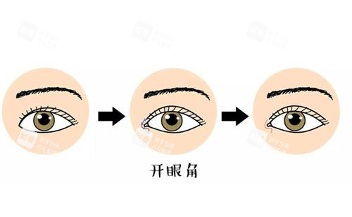 开眼角前后对比漫画图 开眼角前后对比漫画图