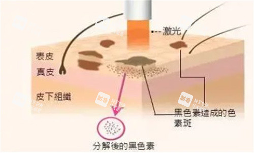 激光祛斑手术原理图