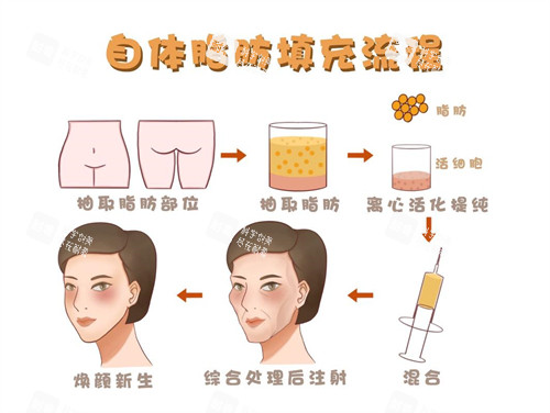 面部自体脂肪填充流程演示动画图 面部自体脂肪填充流程演示动画图