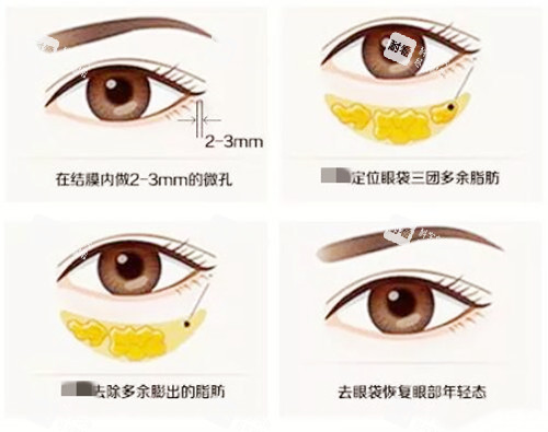 去眼袋过程图示