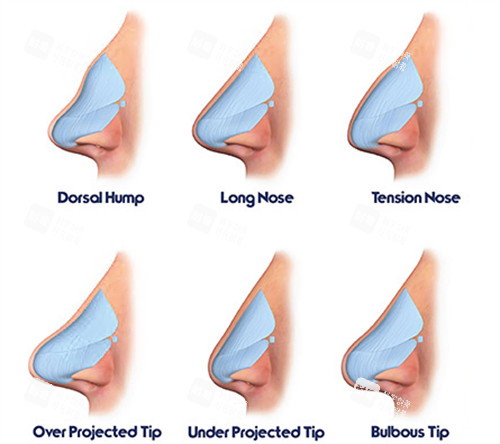 鼻部整形动画演示图
