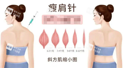 瘦身针瘦斜方肌