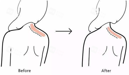 瘦身针注射前后