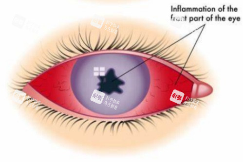 葡萄膜炎 (3) 葡萄膜炎 (3)