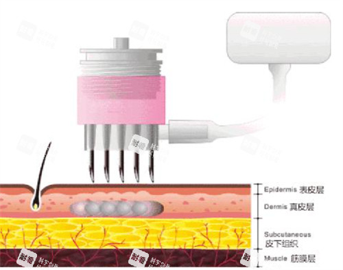 微针可以达到的肌肤层次图解 微针可以达到的肌肤层次图解