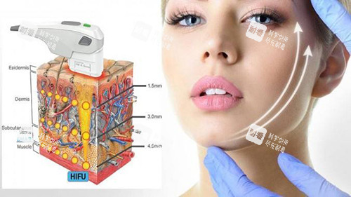 热玛吉 通用图 热玛吉 通用图