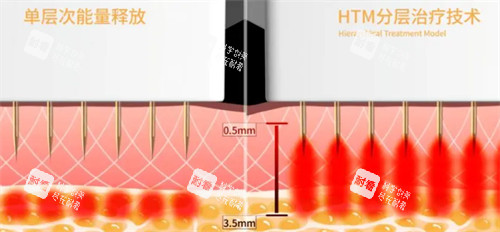 黄金微针技术介绍