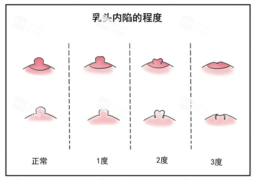 乳头内陷的程度演示图