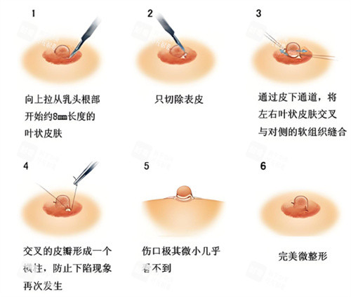 乳头内陷矫正手术过程