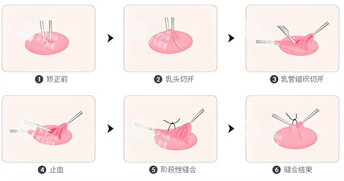 乳头内陷手术步骤图解