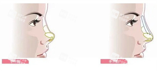隆鼻手术前后对比 隆鼻手术前后对比