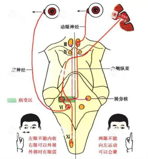 眼肌麻痹症状检测