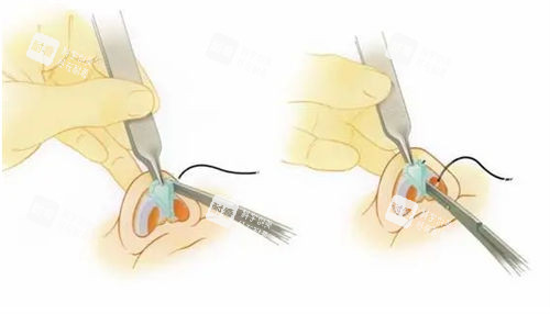 隆鼻手术鼻头过程展示图 隆鼻手术鼻头过程展示图