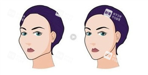 磨骨手术前后对比 磨骨手术前后对比