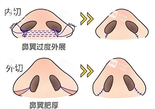 鼻翼缩小内切外切对比