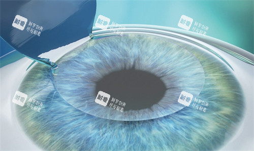 近视手术制瓣中