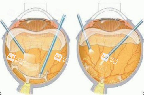 玻璃体切除术过程