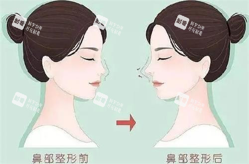 液态隆鼻前后的区别