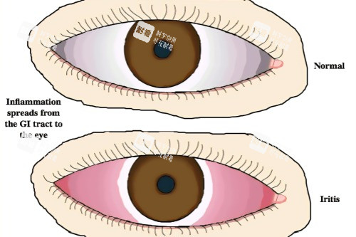 虹膜炎与健康眼睛对比
