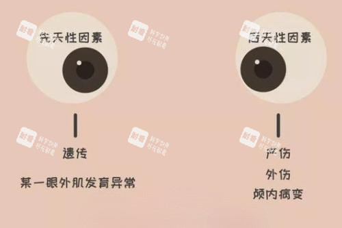 眼睛斜视产生原因卡通图片