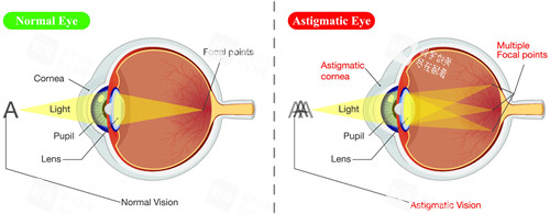 散光眼睛看不清楚东西的原理