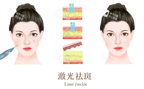 激光祛斑前后