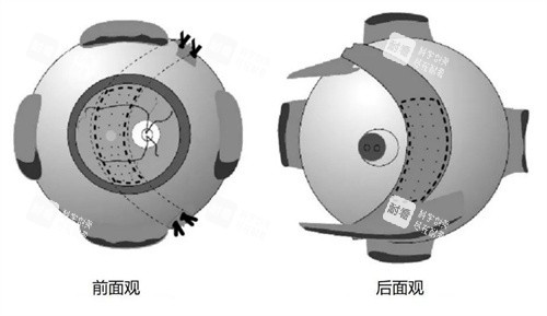 真实术例：薛安·全后巩膜收缩术全过程分享！我的近视眼手术前后对比变化太明显了！